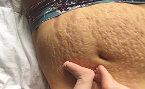 90 Brutally Honest Photos Of Post-Baby Bodies, That Women Are Sharing To Reveal The Truth No One Talks About