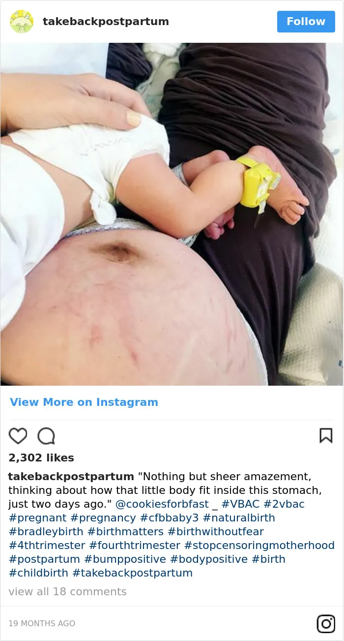 90 Brutally Honest Photos Of Post-Baby Bodies, That Women Are Sharing To Reveal The Truth No One Talks About