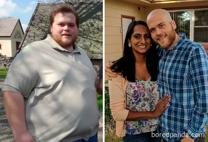 425 Lbs - 175 Lbs: One Week Post Skin Surgery