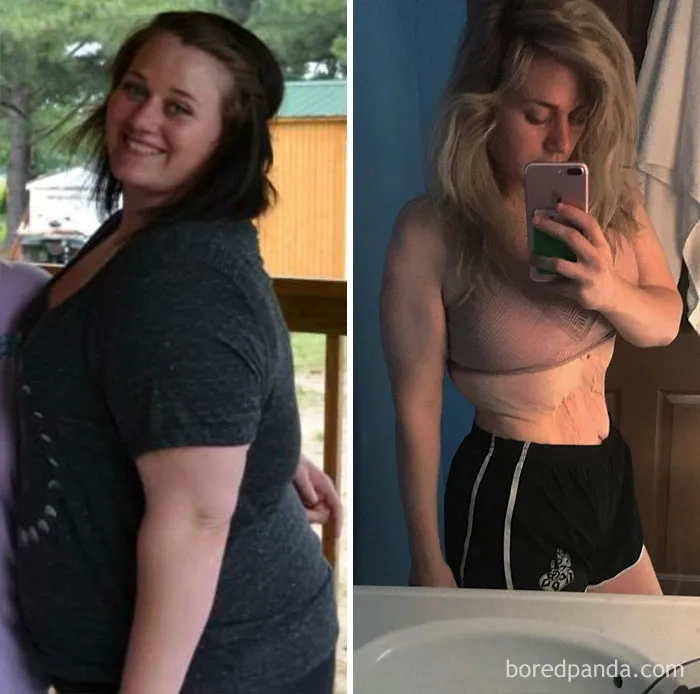 130 Lbs Lost. This Is The First Time I’ve Ever Posted Something Without A Baggy Shirt On Because Of My Skin, But I’m Finding Strength In This Journey