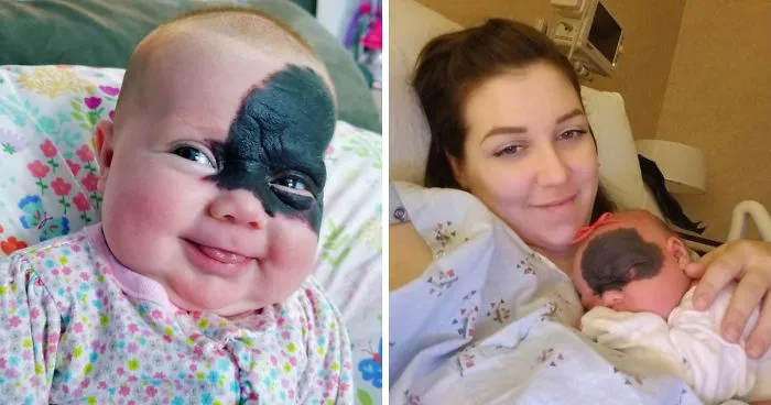 This Baby Was Born With A Birthmark Which Turned Her Into "Little Superhero"