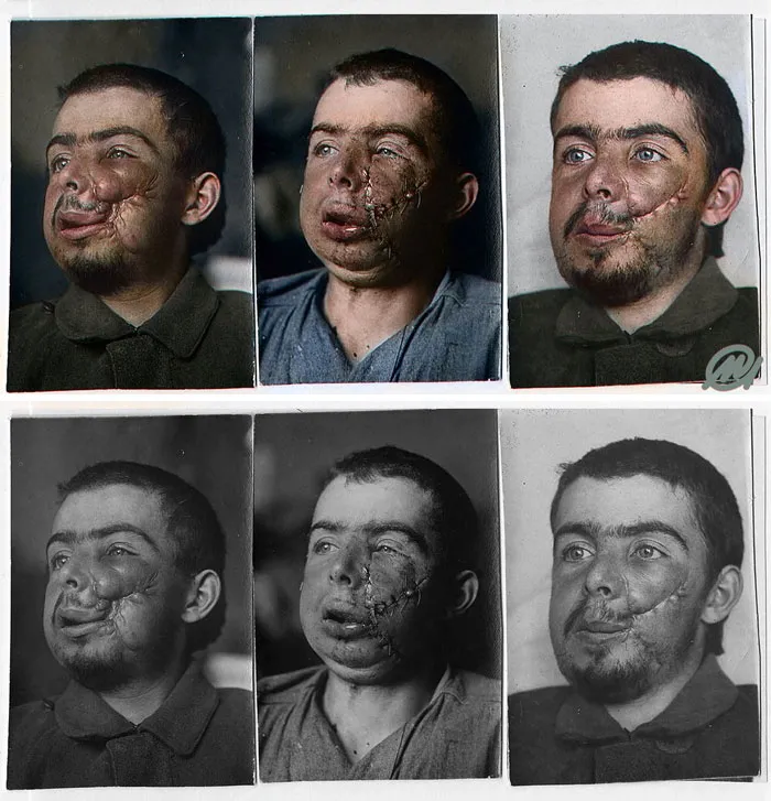 Before And After The Facial Reconstruction Of A Wounded Soldier During World War I