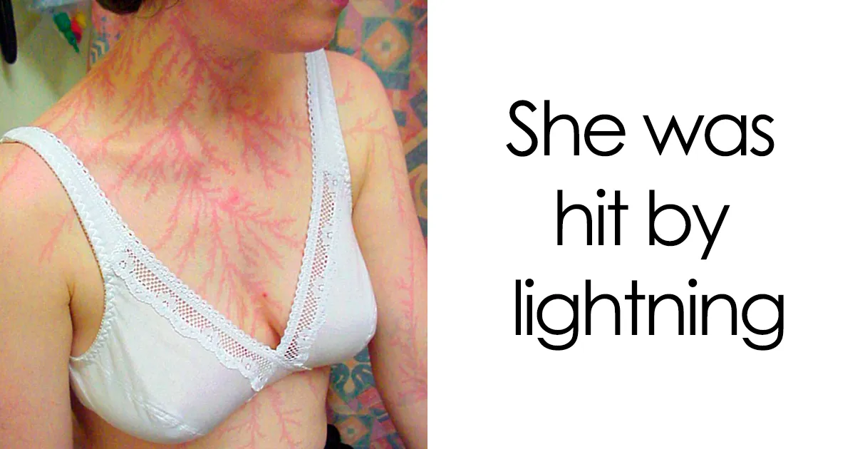 Lichtenberg Scars — Nature’s Tattoo You Don’t Want To Have