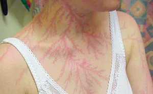 Lichtenberg Scars — Nature’s Tattoo You Don’t Want To Have
