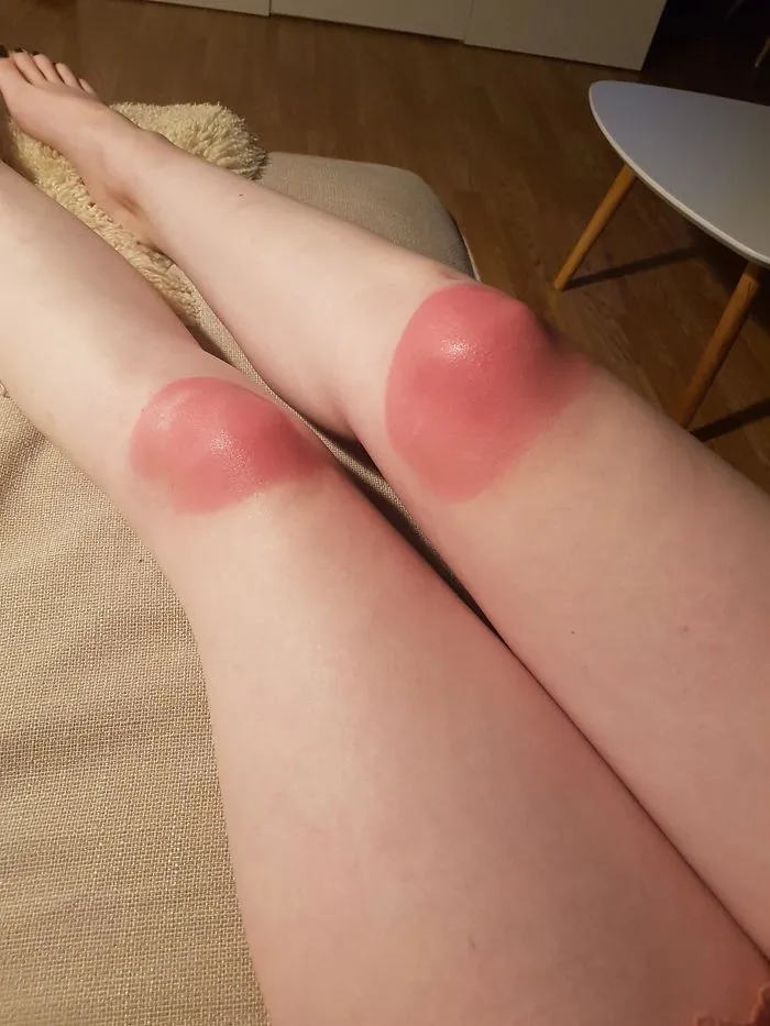 That's Why You Shouldn't Wear Jeans With Holes On Sunny Days