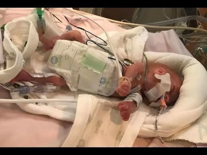 Doctors Thought That This Baby Wouldn’t Survive, But 11 Weeks Later A Minor Miracle Unfolded
