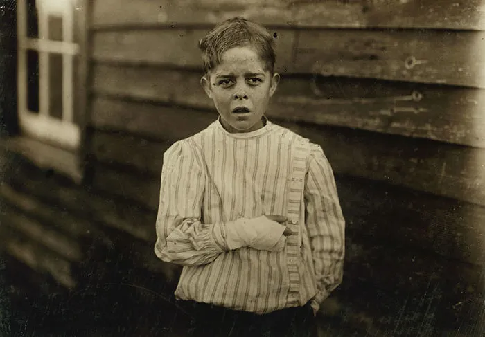 Accident To Young Mill Worker. Giles Edmund Newsom. While Working In Sanders Spinning Mille, A Piece Of The Machine Fell On To His Foot Mashing His Toe. This Caused Him To Fall On To A Spinning Machine And His Hand Went Into Unprotected Gearing, Crushing And Tearing Out Two Fingers. He Told The Attorney He Was 11 Years Old When It Happened. Location: Bessemer City, North Carolina