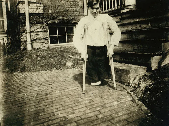 Frank P......., Whose Legs Were Cut Off By A Motor Car In A Coal Mine In West Virginia When He Was 14 Years 10 Months Of Age. Location: Monongah, West Virginia