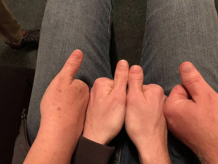Mi cuñado tiene un pulgar de cada uno de sus padres