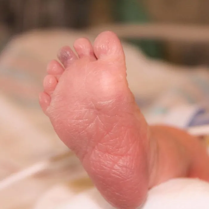 Here Is An Example Of Ryder’s Polydactyly