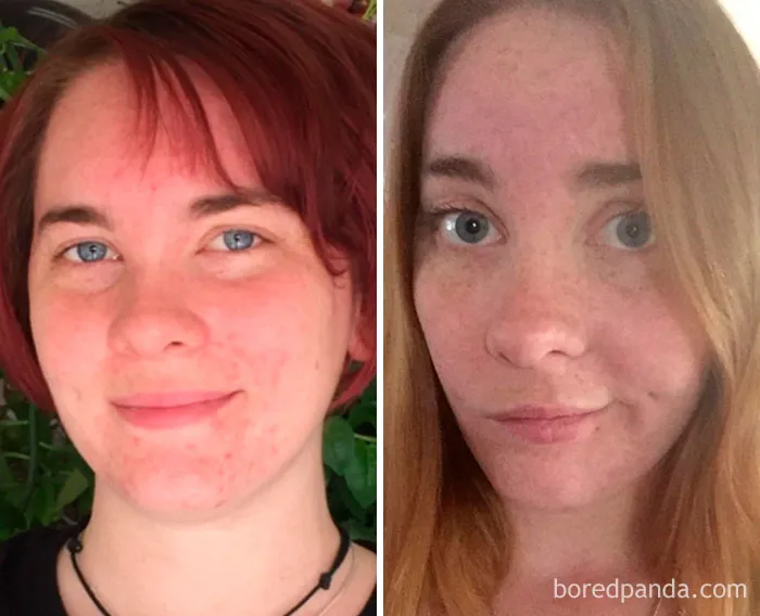 Before and after photos showing changes from stopping drinking alcohol.