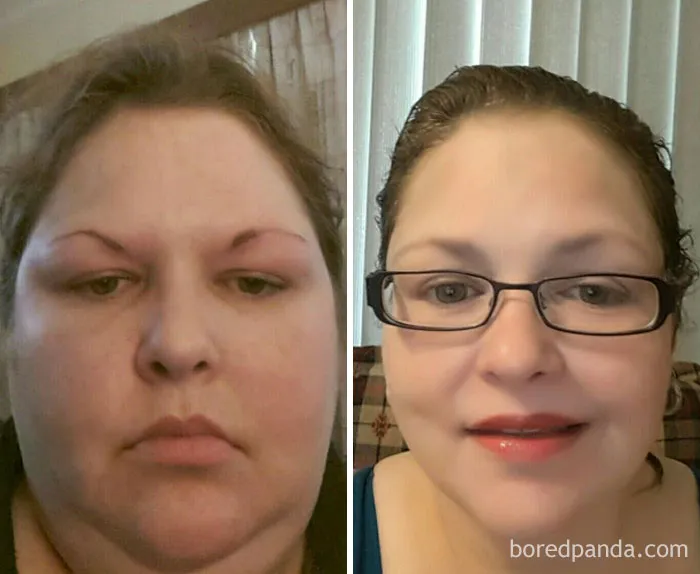 Lost 92 Lbs In 2 Years. Still Quite A Ways To Go To My Goal Of 130 Lbs. But Pretty Happy With The Progress In My Face So Far