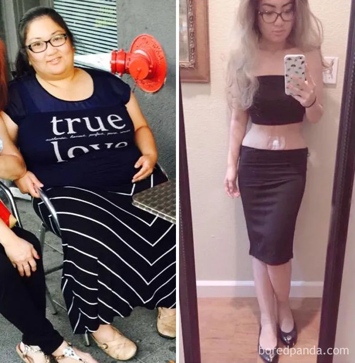 After Losing 150 Lbs With VSG, I'm Amazingly Happy With The Results Of My Skin Removal Surgery