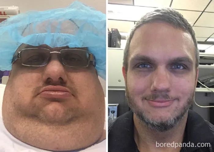 Facial Progress - 206 Lbs Lost