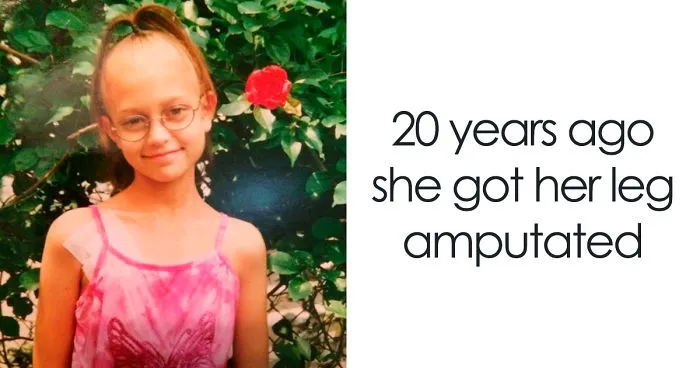 Girl Gets Her Leg Amputated At Age 11 Because Of Cancer, Becomes A Model 20 Years Later