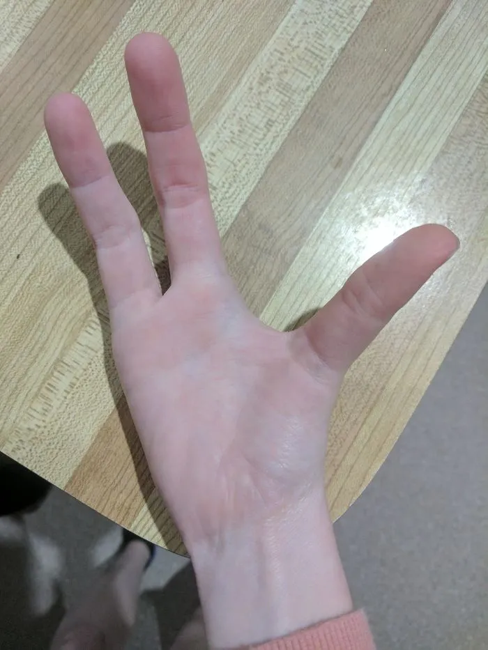 I Was Born Missing My Right Pinky And Thumb