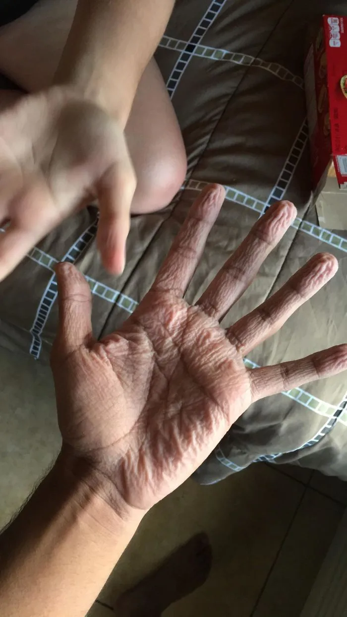 Abnormally Pruney Fingers?? Every Time I Go Swimming With Anyone My Hands Are Always 10x More Wrinkly Than Anyone Else’s