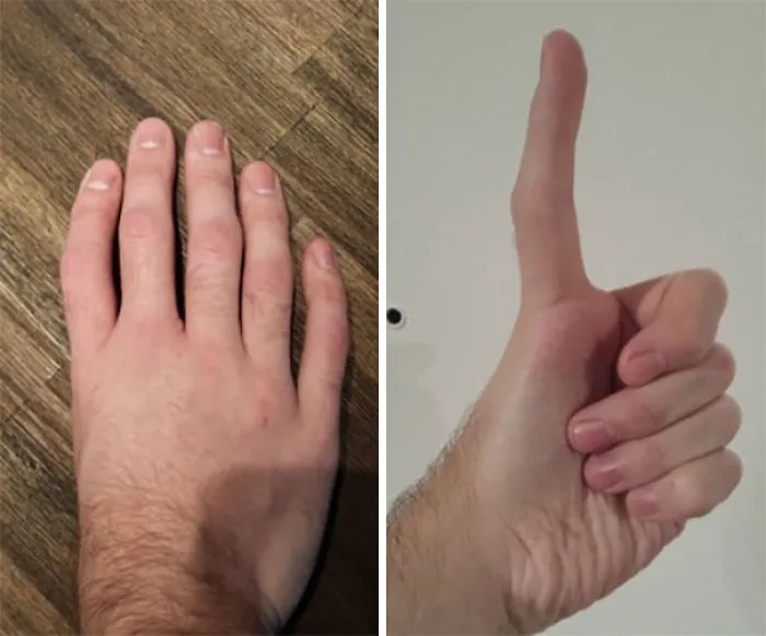 Five Fingers, No Thumb