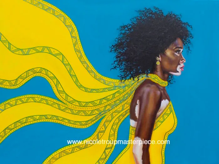 Vitiligo Beauty