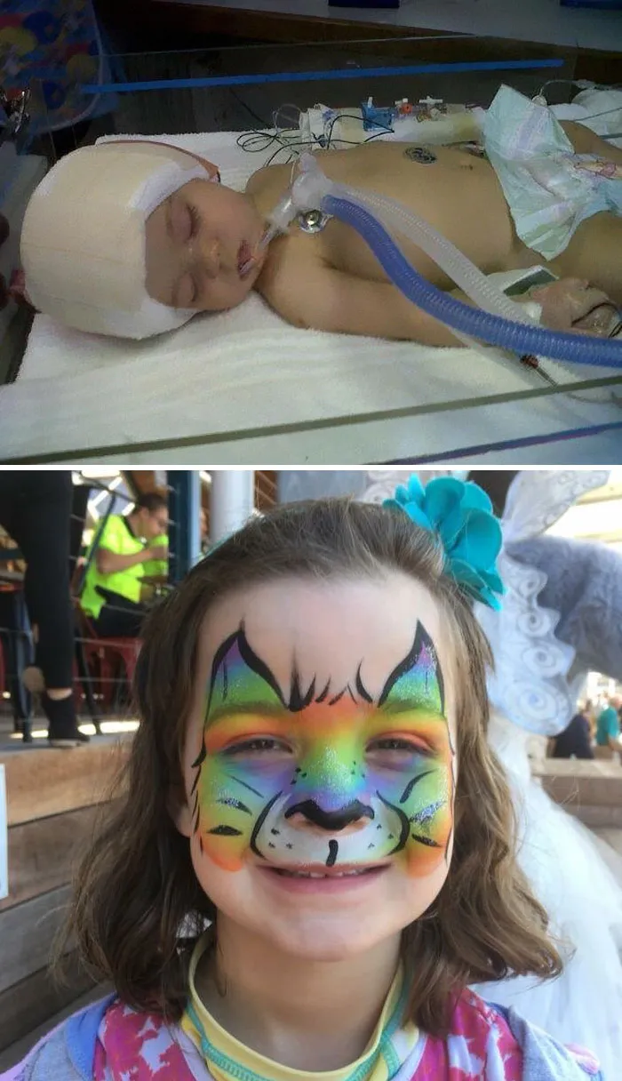 My Daughter Was Born With Craniosynostosis. At 8 Months, Her Skull Was Removed And Reshaped. Today, She Is A Healthy, Happy 7 Year Old! Go Miles!