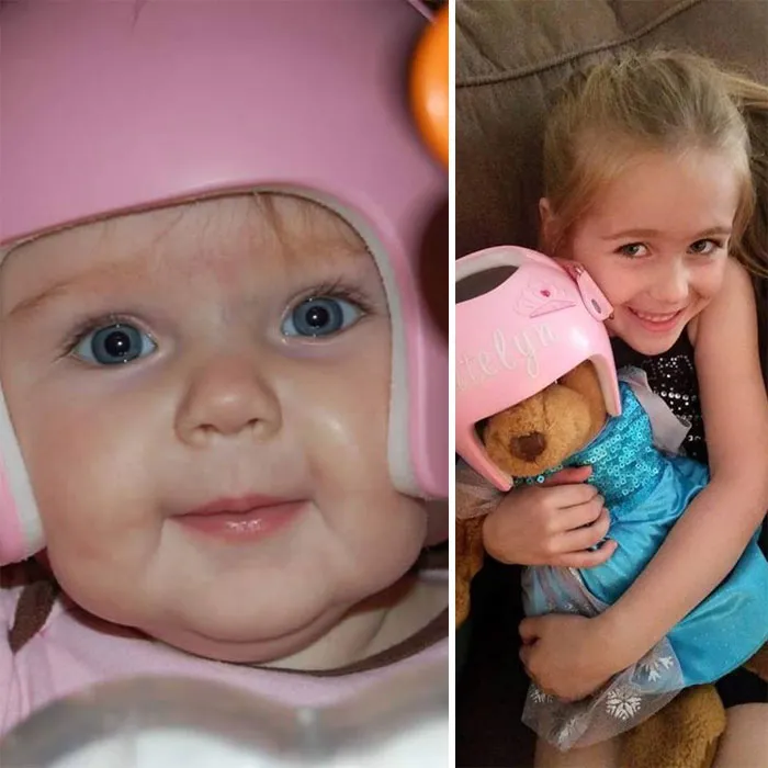 My Daughter Wore One To Fix Her Plagiocephaly Due To Torticollis At Birth. She's 7 Now And Her Dolls And Bears Wear The Helmet Sometimes