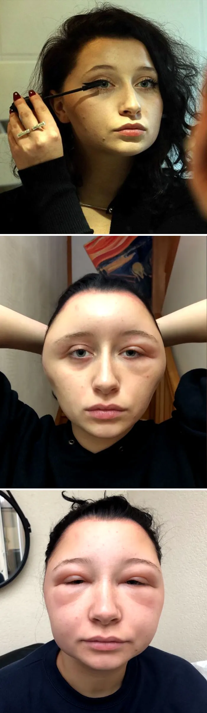 An Allergic Reaction To Hair Dye