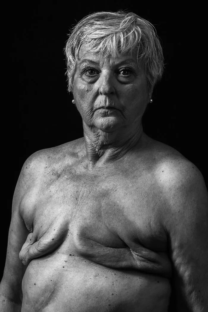 Breast Cancer, Huey Kidd
