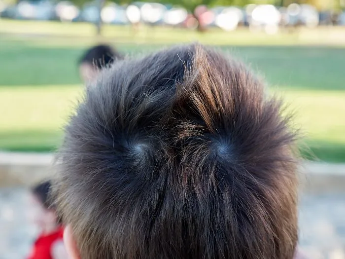 Mi hijo tiene remolinos simétricos en el pelo que van en direcciones opuestas
