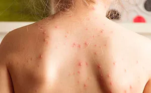 Anti-Vaxx Mom Asks How To Protect Her Unvaccinated 3-Year-Old From The Measles Outbreak, Internet Delivers