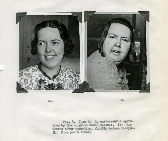 21 Disturbing Pictures of Lobotomy Before and After