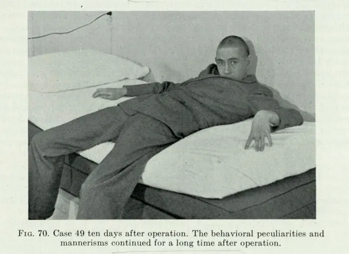 21 Disturbing Pictures of Lobotomy Before and After