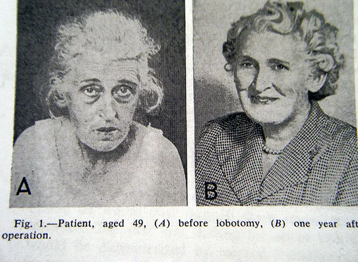 21 Disturbing Pictures of Lobotomy Before and After