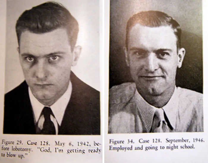 21 Disturbing Pictures of Lobotomy Before and After