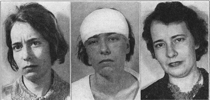 21 Disturbing Pictures of Lobotomy Before and After