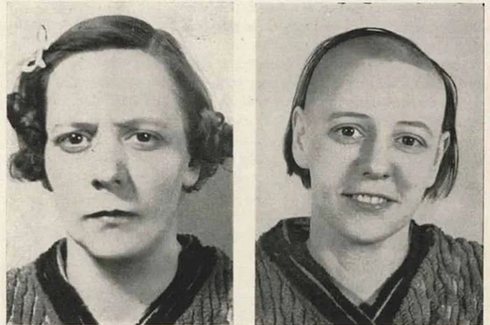 21 Disturbing Pictures of Lobotomy Before and After