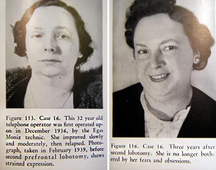 21 Disturbing Pictures of Lobotomy Before and After