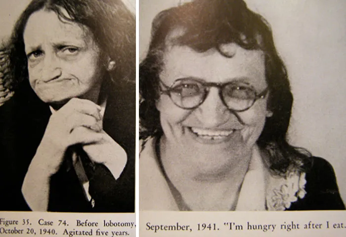 21 Disturbing Pictures of Lobotomy Before and After