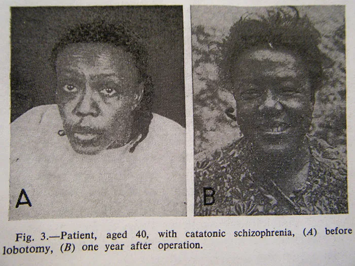 21 Disturbing Pictures of Lobotomy Before and After