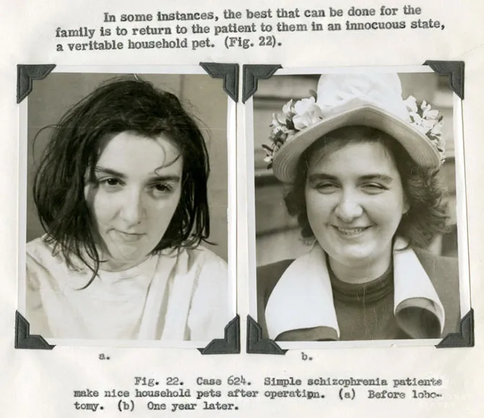 21 Disturbing Pictures of Lobotomy Before and After