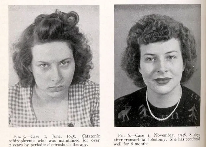 21 Disturbing Pictures of Lobotomy Before and After