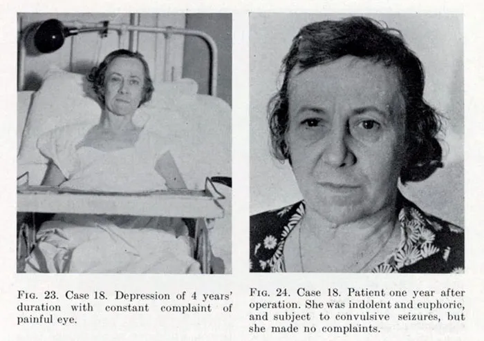 Lobotomy: When Science Went Too Far