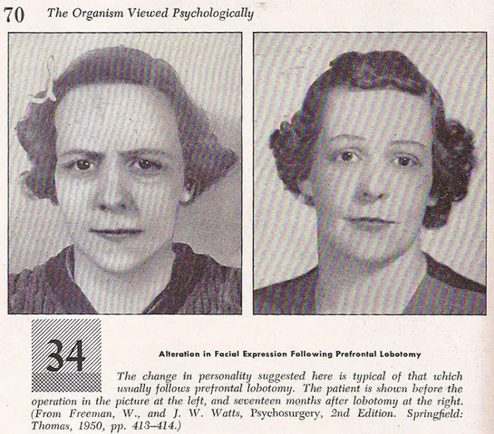 Before and after images of a woman showing facial expression changes following a prefrontal lobotomy.