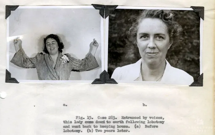 21 Disturbing Pictures of Lobotomy Before and After