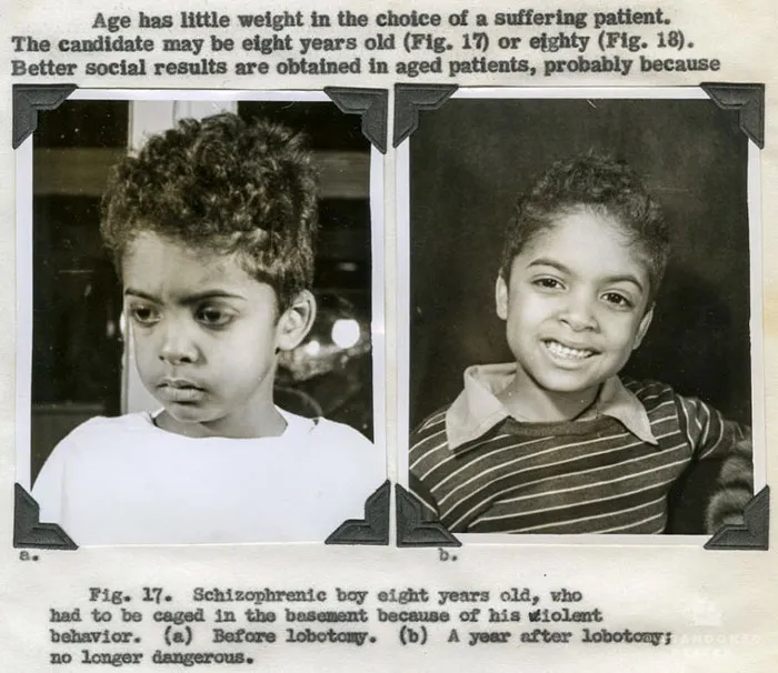 Before And After: The Tragedy Of Lobotomy