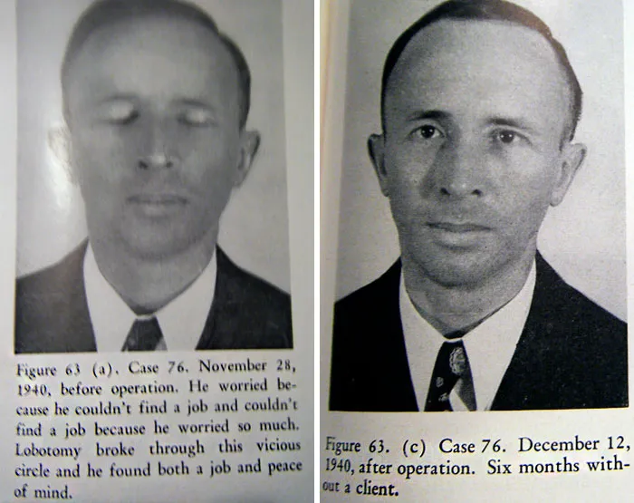 21 Disturbing Pictures of Lobotomy Before and After