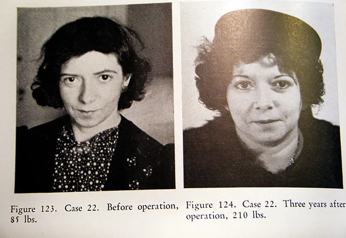 21 Disturbing Pictures of Lobotomy Before and After
