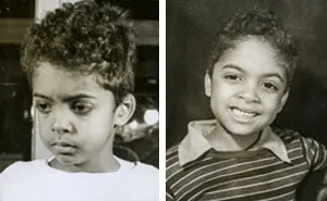21 Disturbing Pictures of Lobotomy Before and After