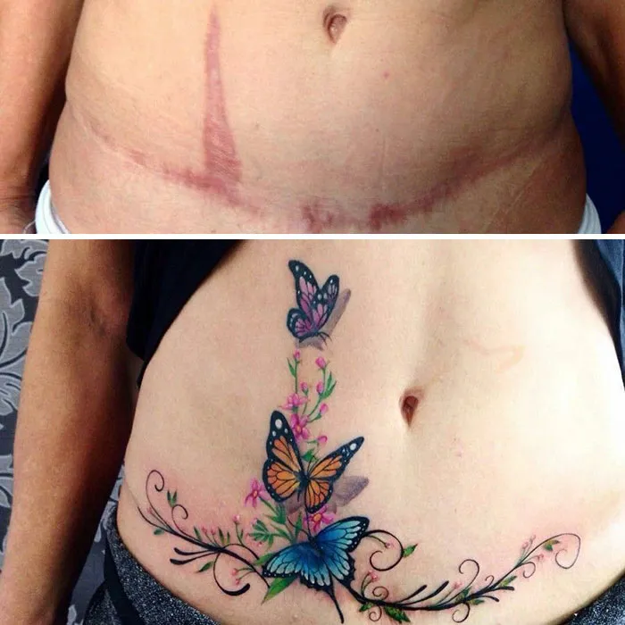 40 Tatuadores que triunfaron cubriendo cicatrices y marcas de nacimiento