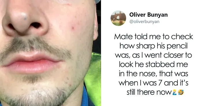 Apparently, Pencil Scars Are A Thing And There Are More People Affected Then You Would Think