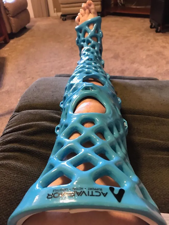 La escayola de mi madre está impresa en 3D y se puede duchar con ella